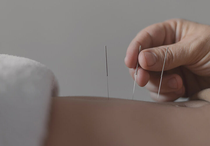 Acupuncture - The Well Medical Clinic
