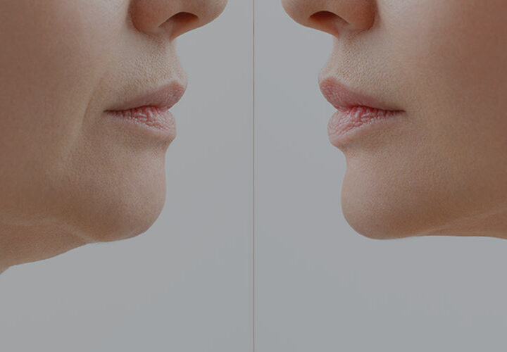 Non Surgical Face Lifting - The Well Medispa & Laser Clinic