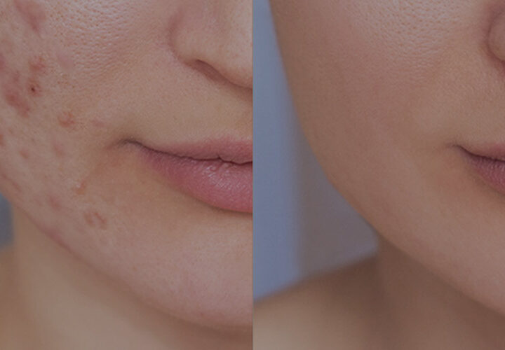 Acne / Acne Scars - The Well Medispa & Laser Clinic