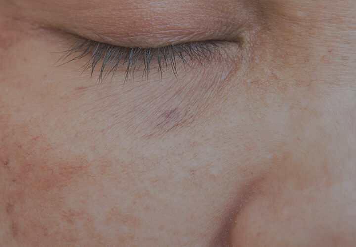 Pigmentation / Melasma - The Well Medispa & Laser Clinic | The Well Medical Clinic