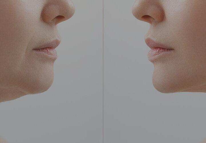 Non Surgical Face Lifting - The Well Medispa & Laser Clinic | The Well Medical Clinic