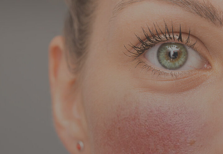 Rosacea / Flushing Treatment - The Well Medispa & Laser Clinic | The Well Medical Clinic