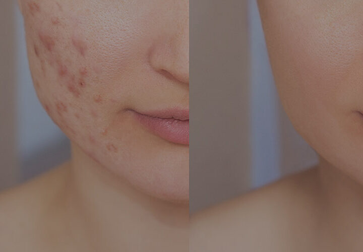 Acne / Acne Scars - The Well Medispa & Laser Clinic | The Well Medical Clinic