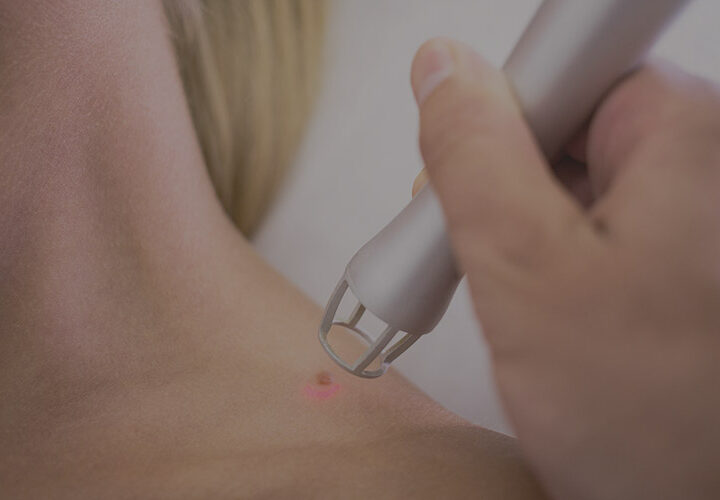 Co2 Laser Removal - The Well Medispa & Laser Clinic | The Well Medical Clinic